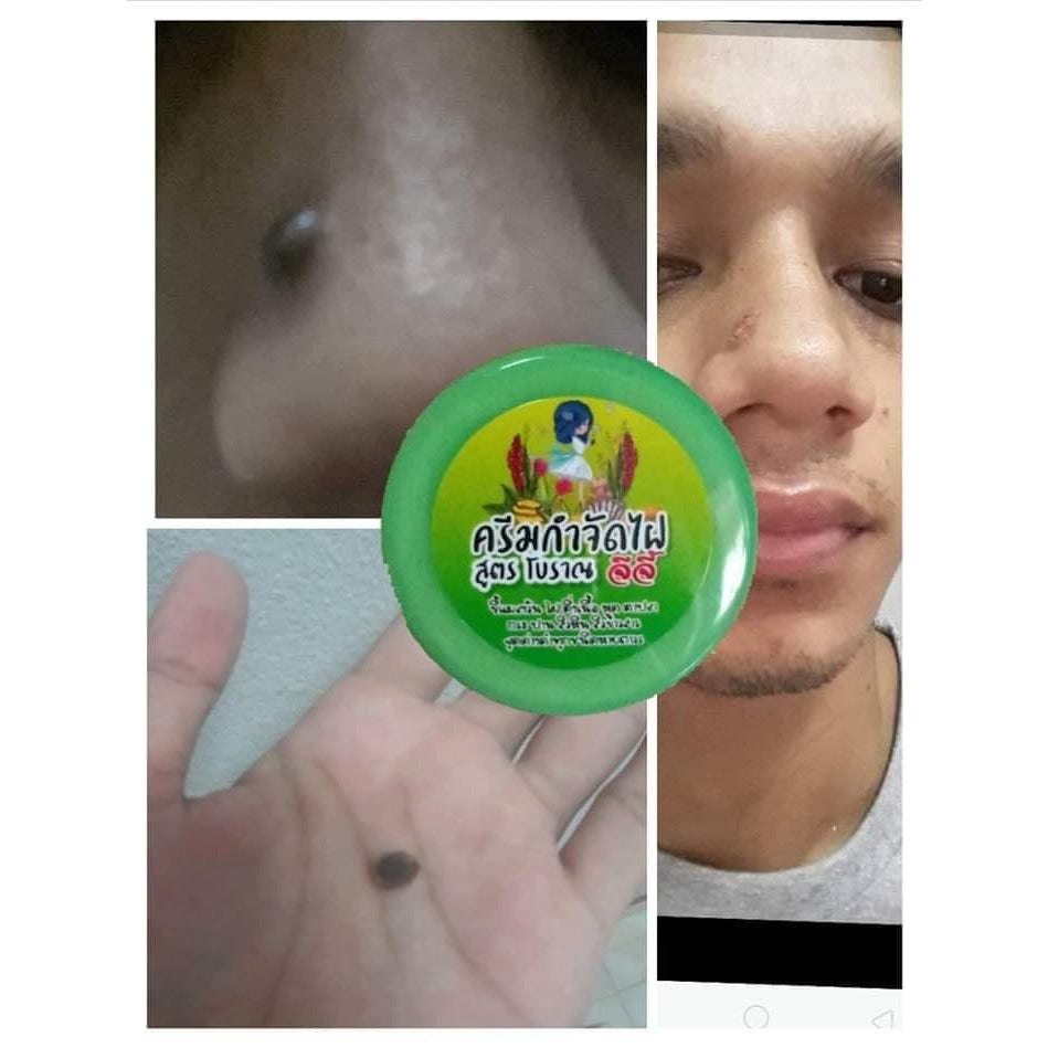 ครีมจีจี้ กำจัดไฝ ขี้แมลงวัน หูด ตาปลา สูตรสมุนไพรโบราณ 5g.