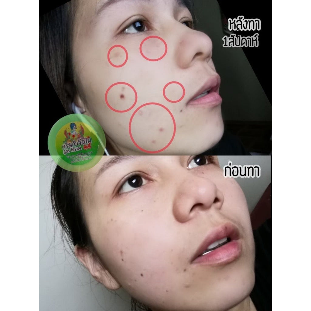 ครีมจีจี้ กำจัดไฝ ขี้แมลงวัน หูด ตาปลา สูตรสมุนไพรโบราณ 5g.