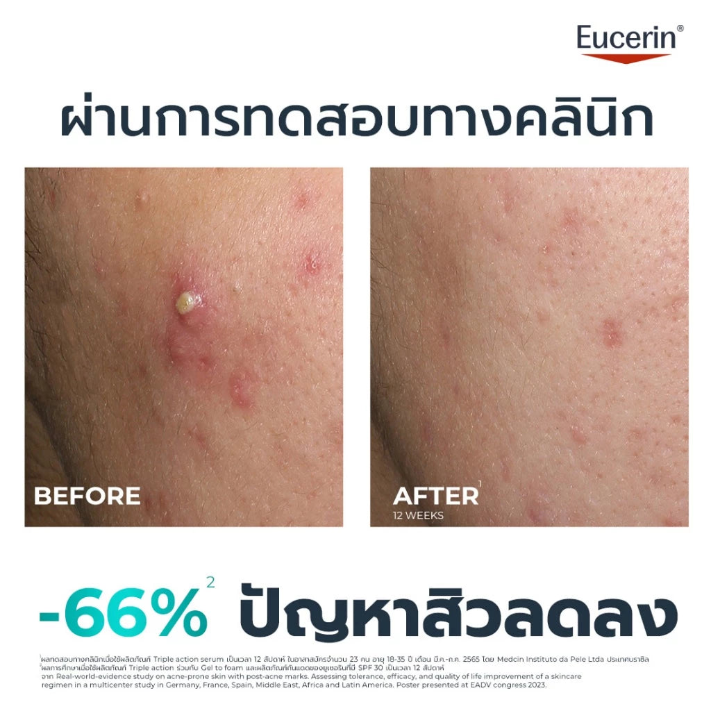 ⛔️ (Pre-order) Eucerin DERMOPURE Clinical Triple Action เซรั่มลดสิว ลดรอย คุมมัน ผิวสมดุล 40ml